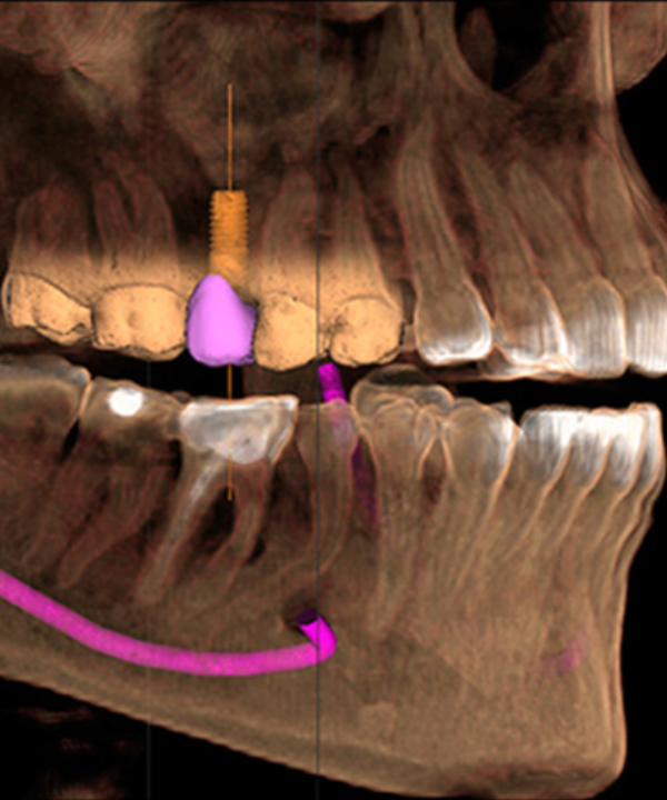 Tomografía Para Implantes Dentales