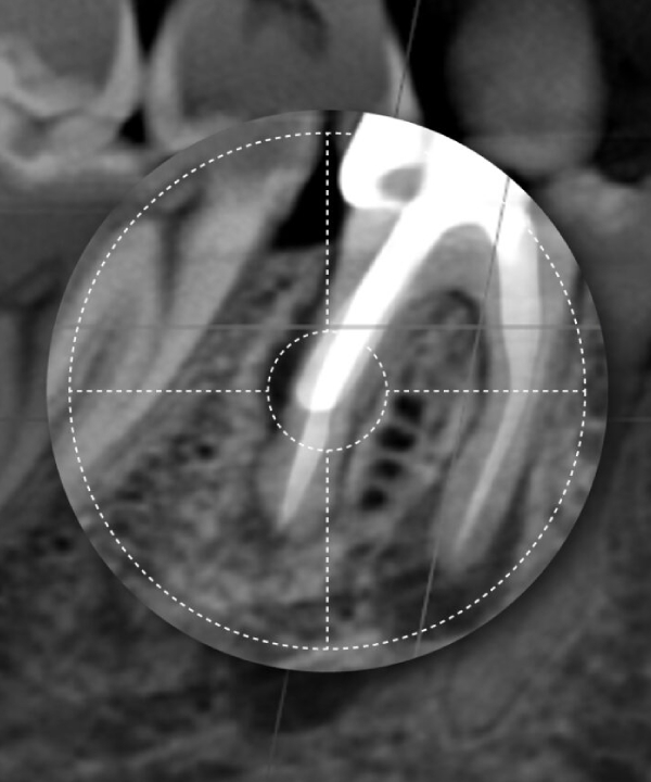 Tomografía Para Endodoncia