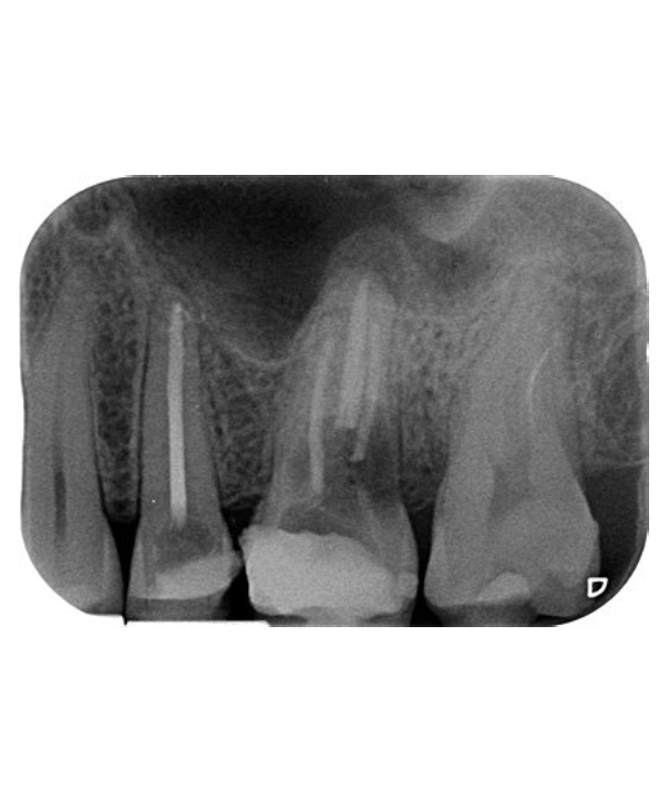 RX Periapical
