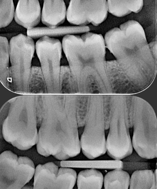 RX Aleta De Mordida