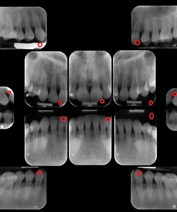 RX Serie Periapical
